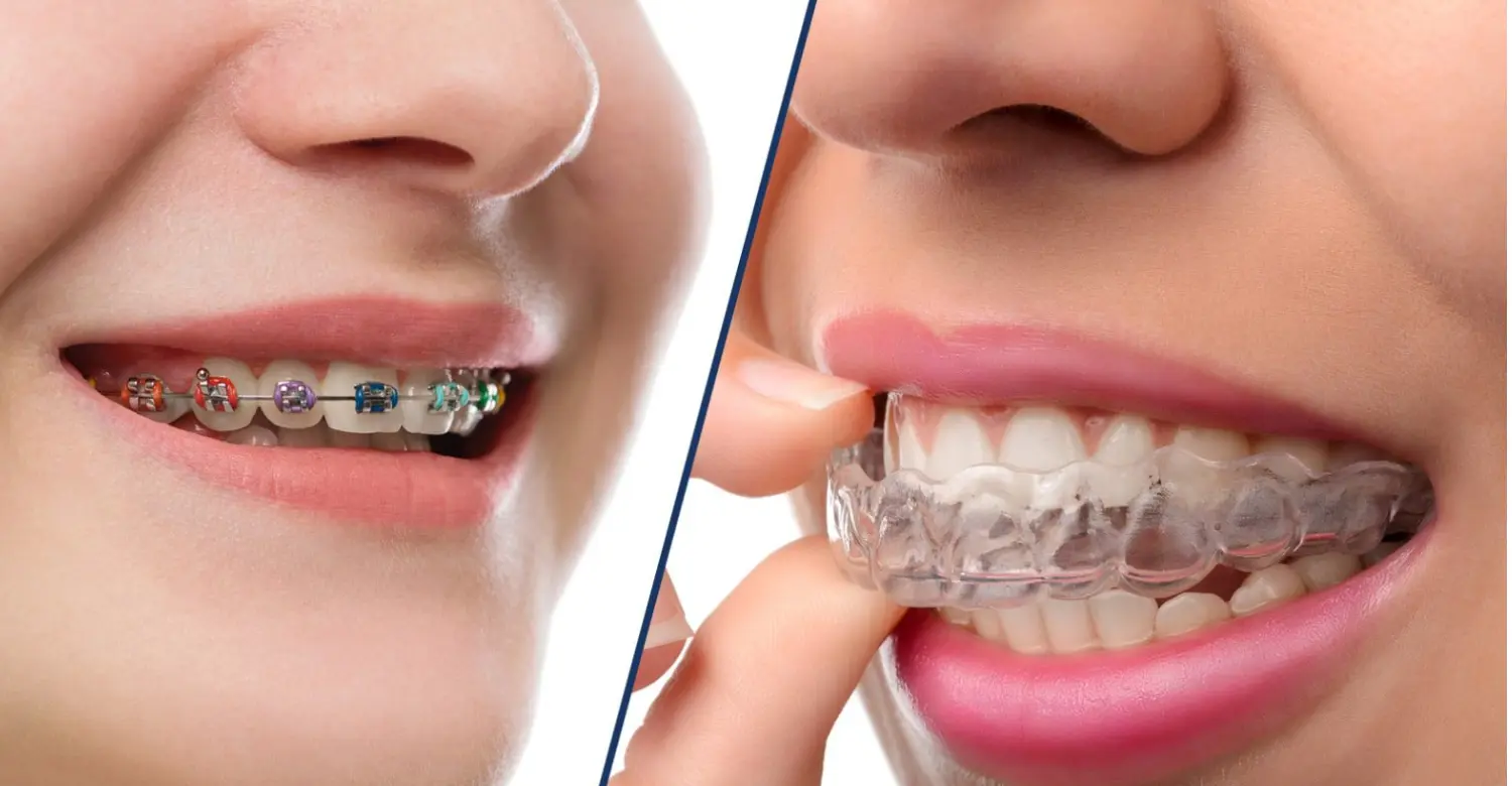 Are Traditional Braces Cheaper Than Invisalign 2